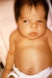 Jaundice in newborn by Dr. Hudson - 5604 US Department of Health and Human Services