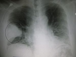 A very prominent pneumonia of the middle lobe of the right lung by James Heilman, MD in wikipedia CC BY-SA 3.0