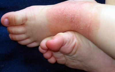 Dupilumab off-label a largo plazo en la dermatitis atópica pediátrica
