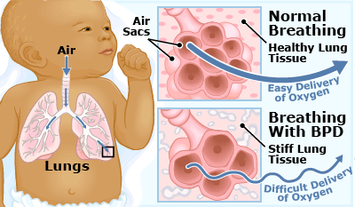 Budesonida inhalada precoz para la prevención de la displasia broncopulmonar