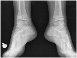 Radiografías de tobillos (lateral)