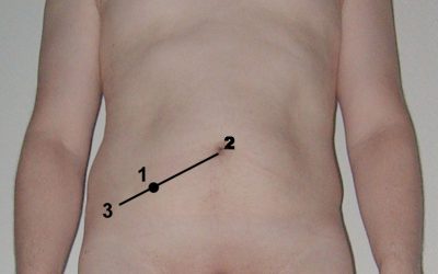 Apendicitis aguda: ¿ecografía abdominal como primera prueba diagnóstica?