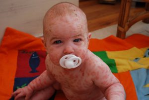 steph 6 months by Mastocytosis Canada in Flikr (CC BY-NC-ND 2.0)