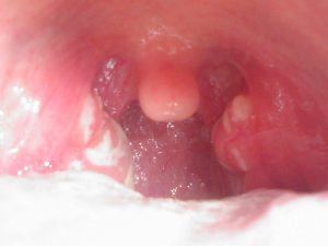 Streptococcal pharyngitis by RescueFF in wikipedia free domain