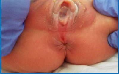 Surco perineal en niñas lactantes