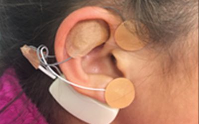 Estimulación percutánea del oído externo como tratamiento del dolor abdominal funcional