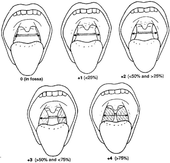 puntuación de hipertrofia amigdalina