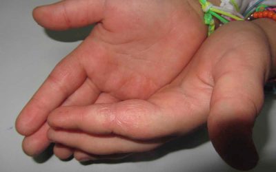 Eccema de manos en población pediátrica