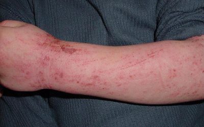Papel del metotrexato en dermatitis atópica