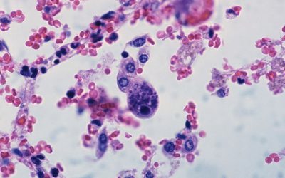 Infección por citomegalovirus, virus de Epstein Barr y virus varicela-zóster y riesgo de atopia