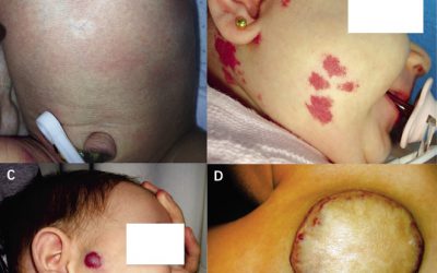 Eficacia y seguridad del timolol tópico para el tratamiento del hemangioma infantil en la etapa proliferativa temprana: ensayo clínico aleatorizado